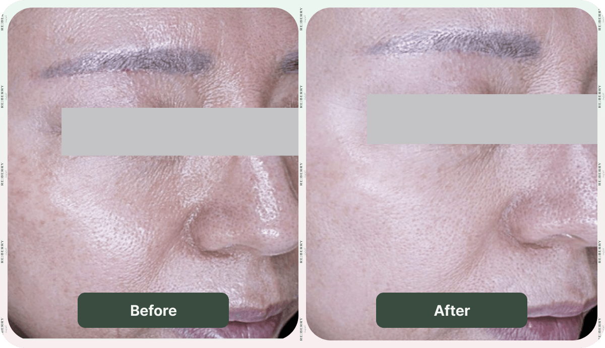 before and after dark spot removal