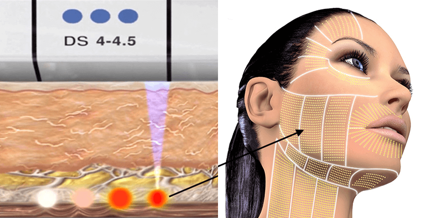 How Ultherapy Works (2)