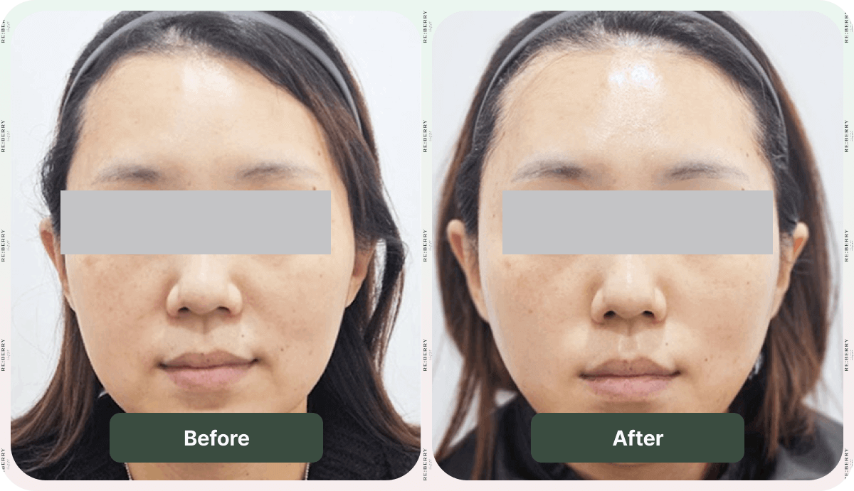 onda lifting before after
