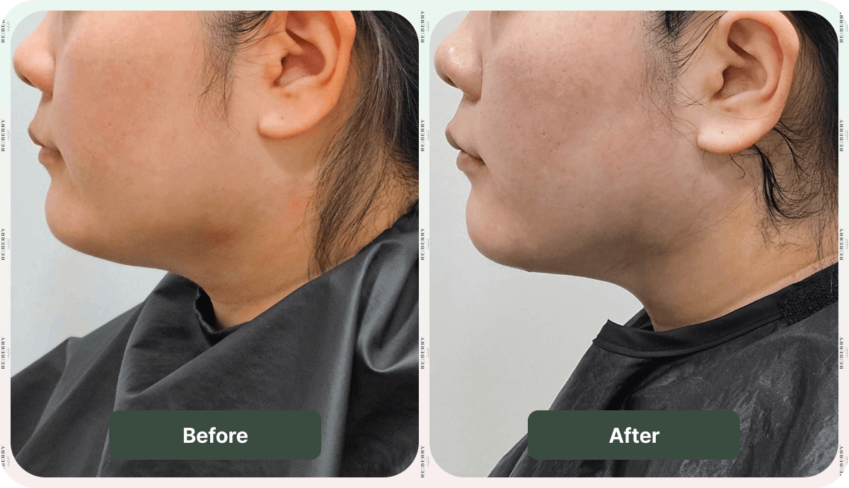 onda lifting before and after