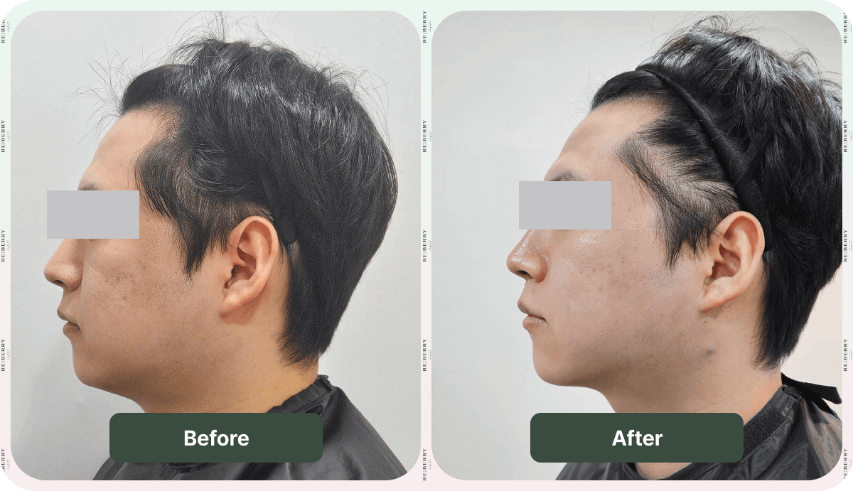 onda lifting before after