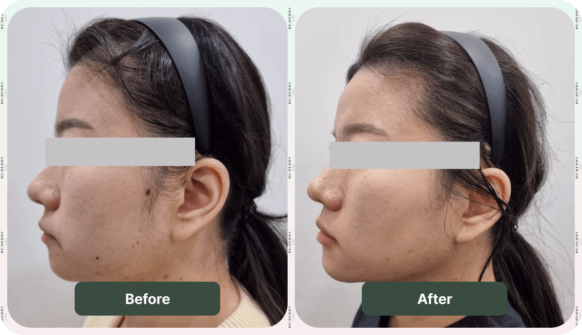 before after face lift
