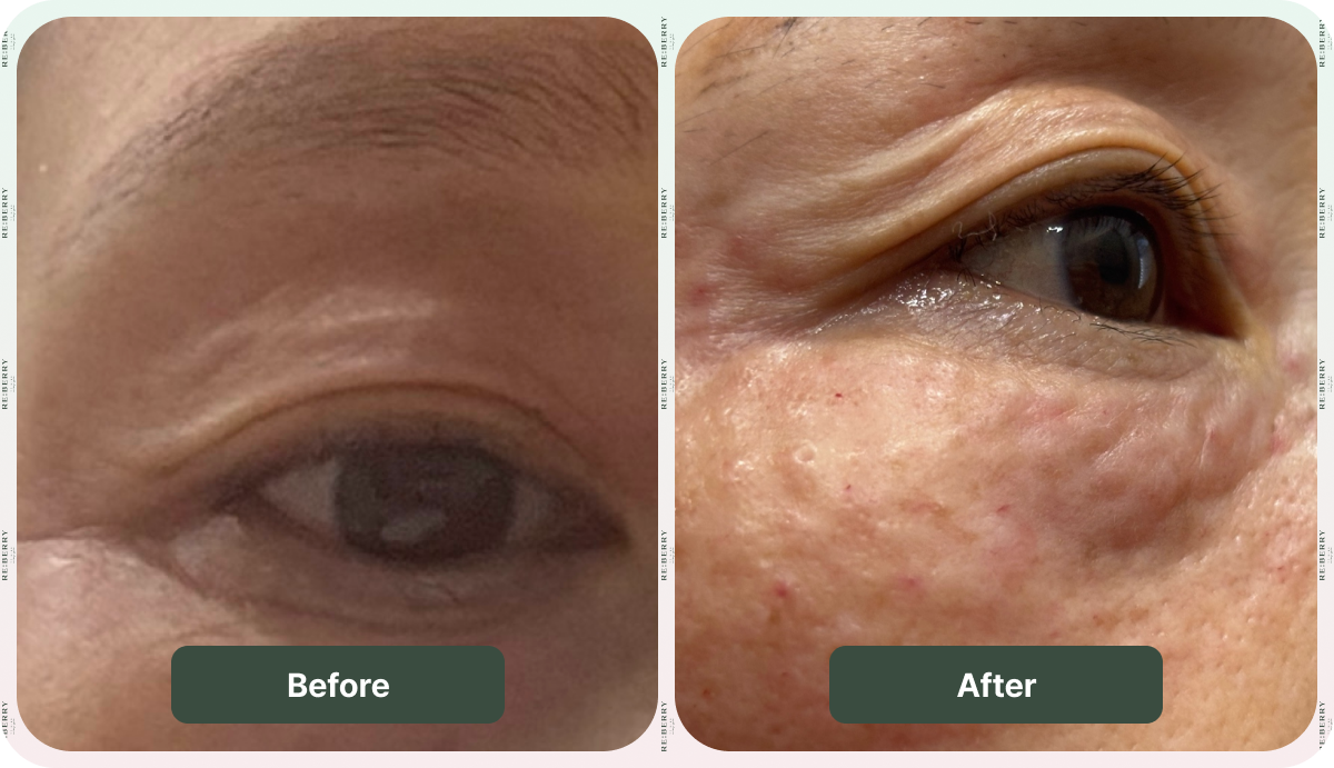 rejuran before and after