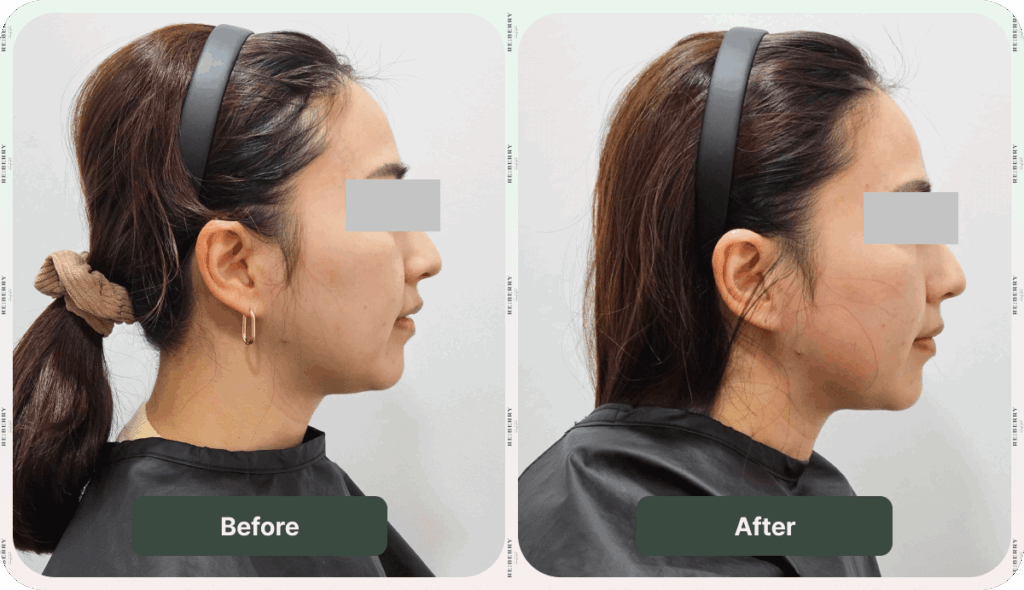 before and after sofwave