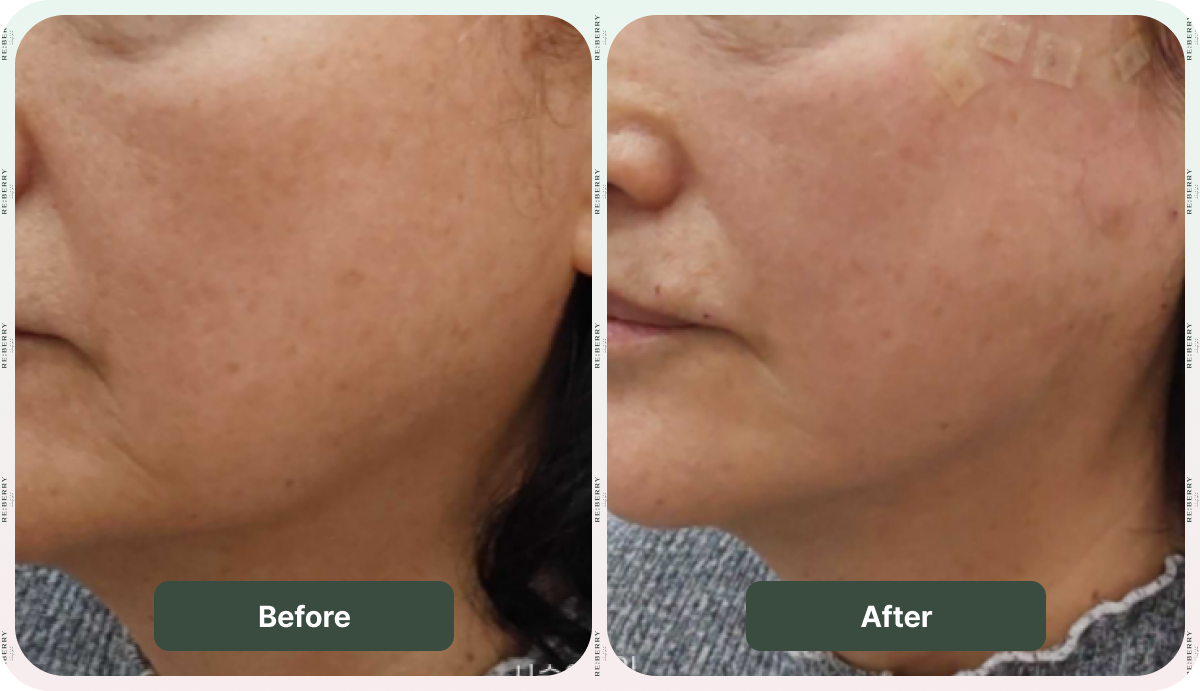 facelift before after