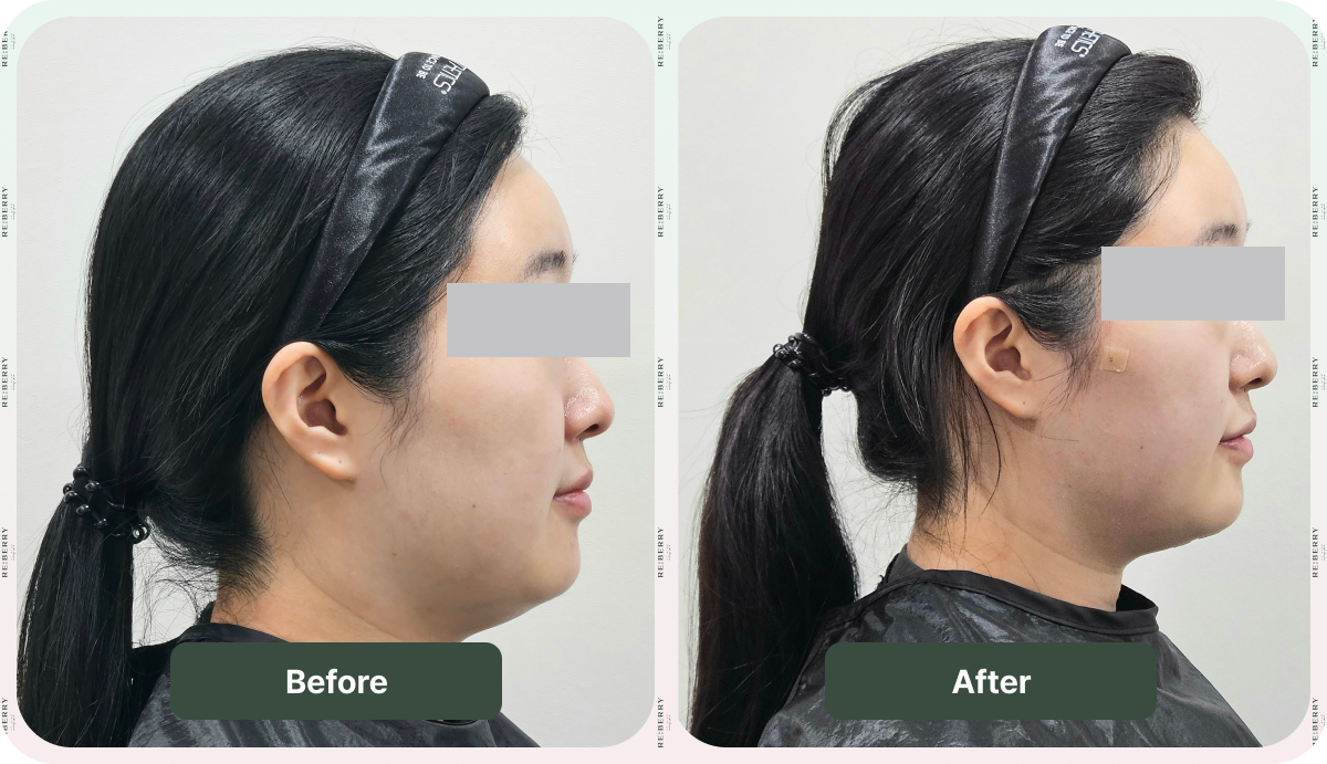 thread lift before after