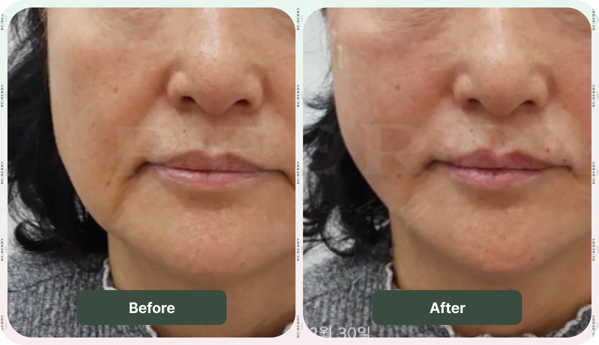 before after thread lift
