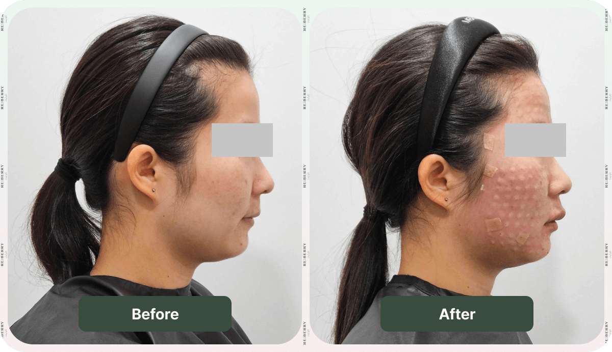 advanced injection before and after