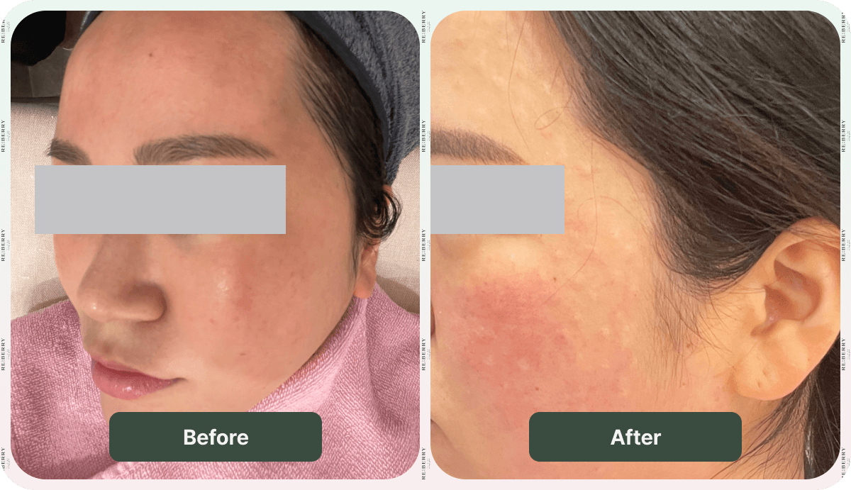 before and afer rejuran injection treatment