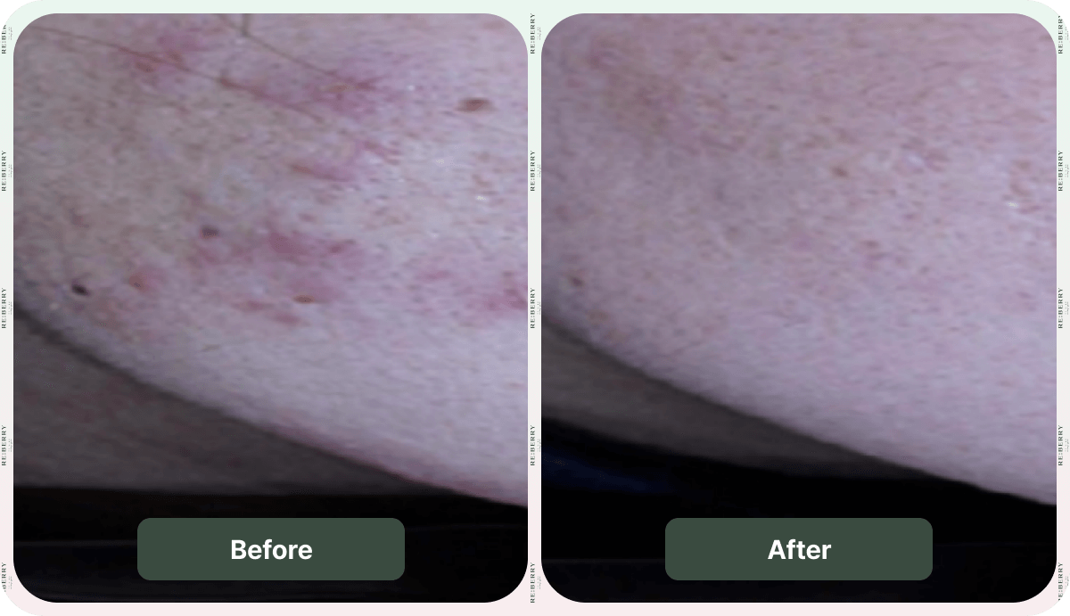 signs on right cheek before and after glass facial treatment