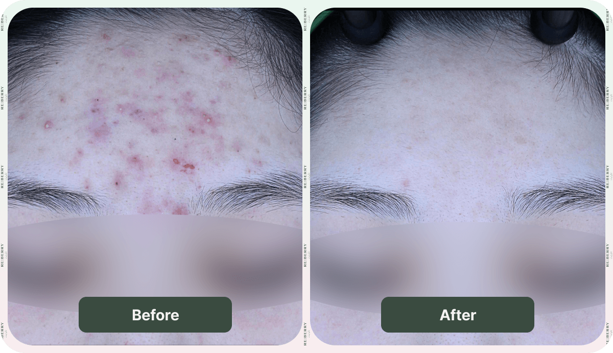 pimples on forehead before and after glass facial