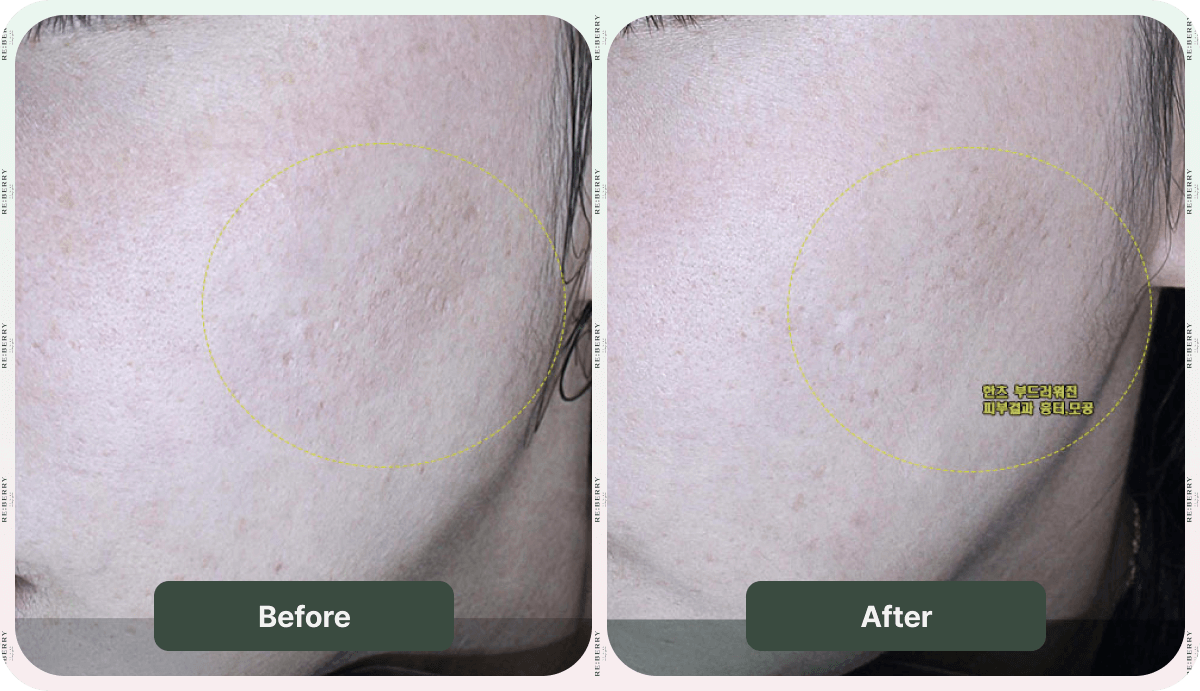 glass facial before and after comparision