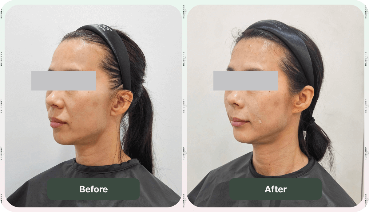 juvelook volume before after