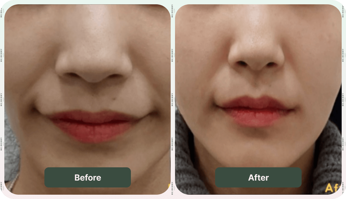 juvelook volume before after
