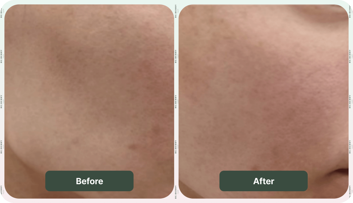 juvelook volume before after