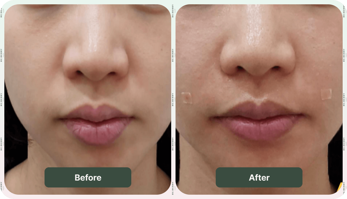 juvelook volume before and after