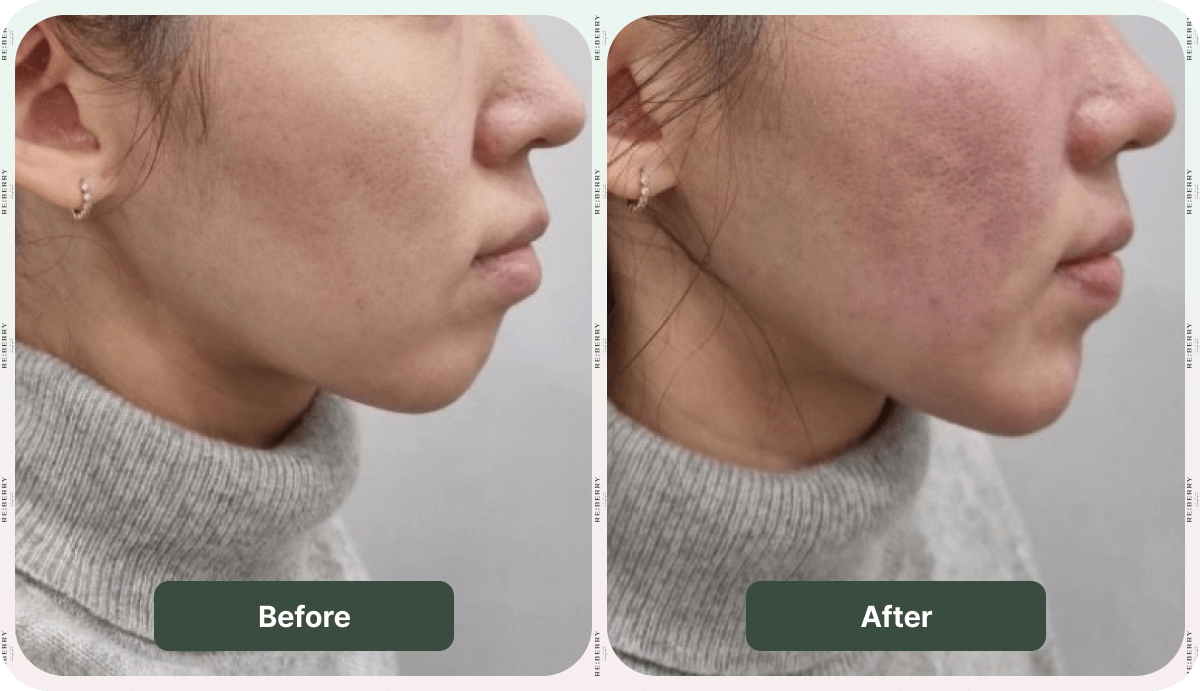 juvelook volume before after