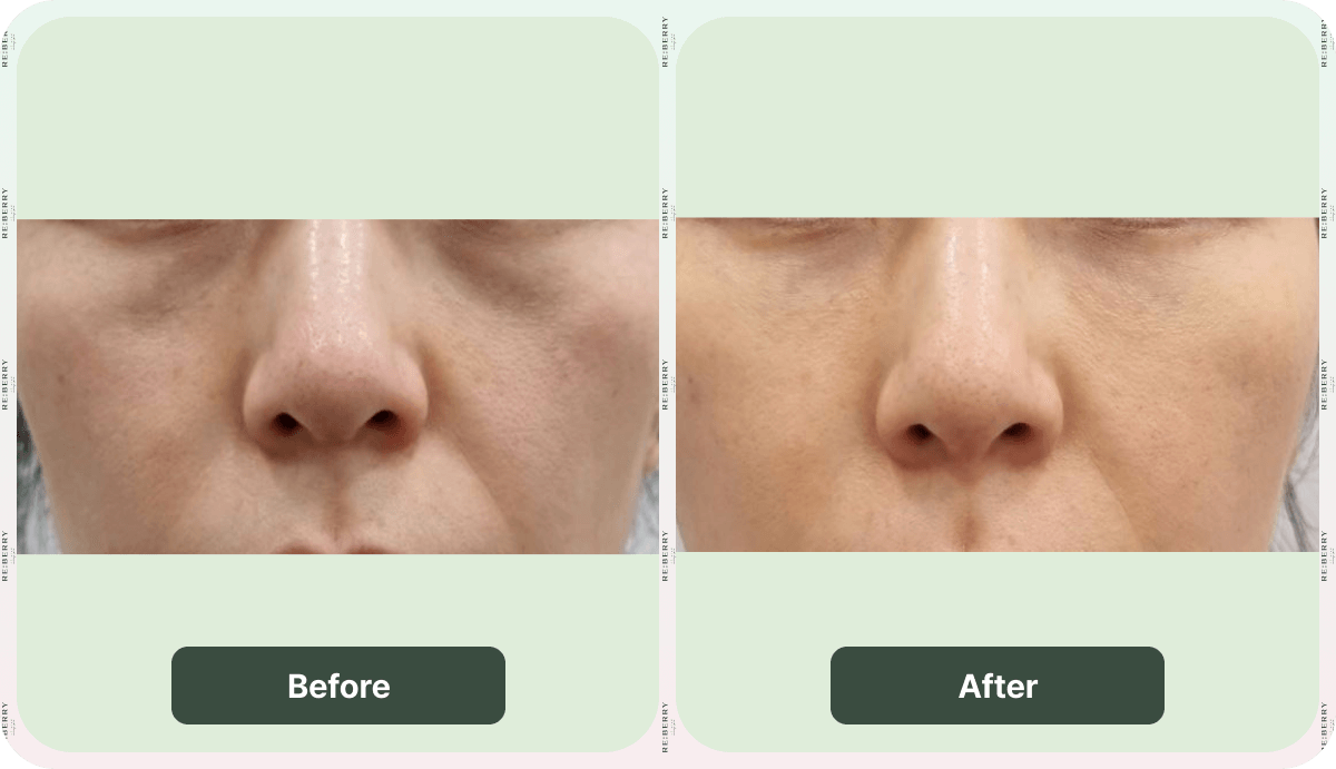 juvelook volume before and after