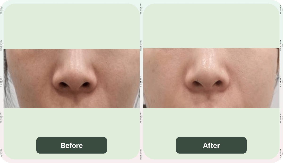 juvelook volume before after