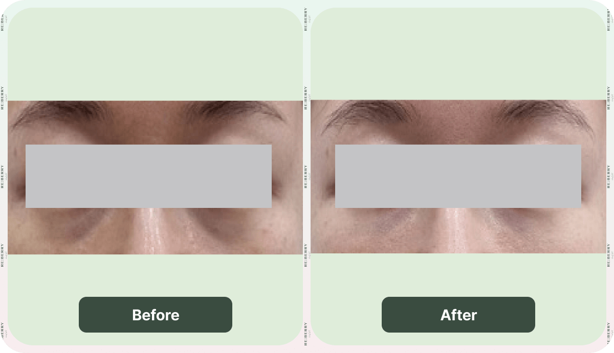 juvelook before and after