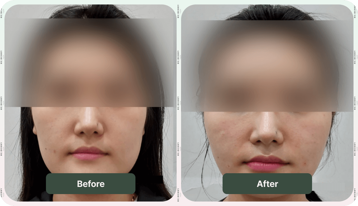 juvelook volume before and after