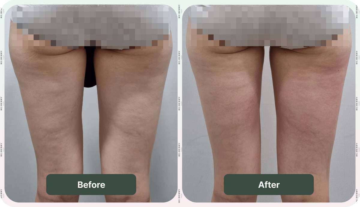 body treatment before and after