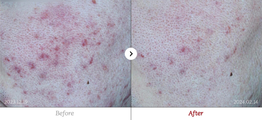 Acne before and after - RE:BERRY