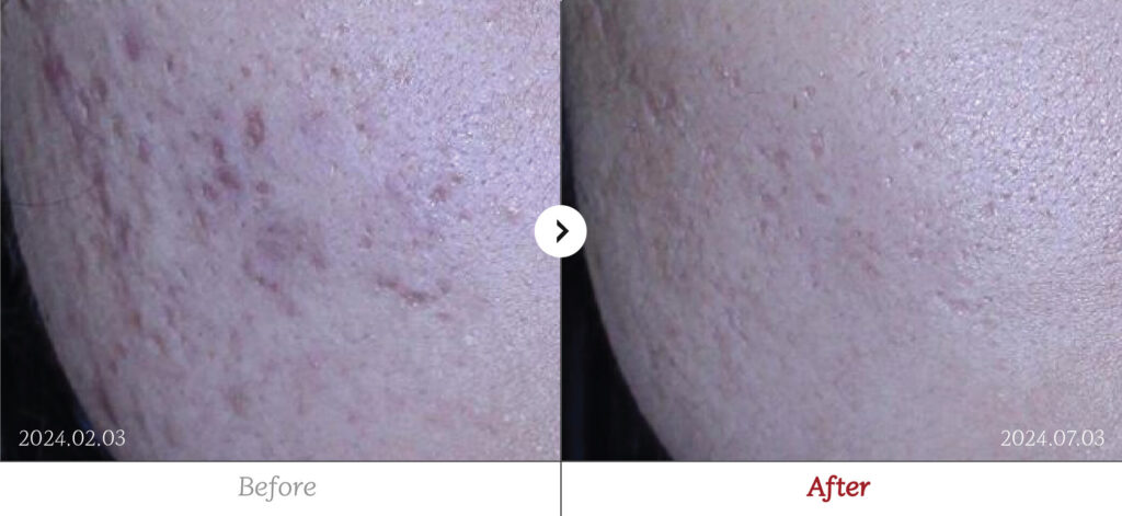 Acne before and after - RE:BERRY