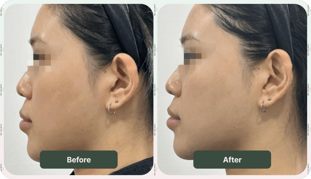 face of woman before and after facial treatment