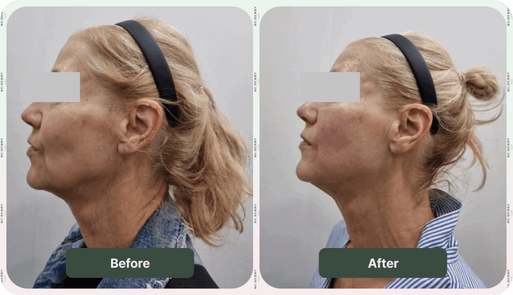 face of woman before and after facial treatment
