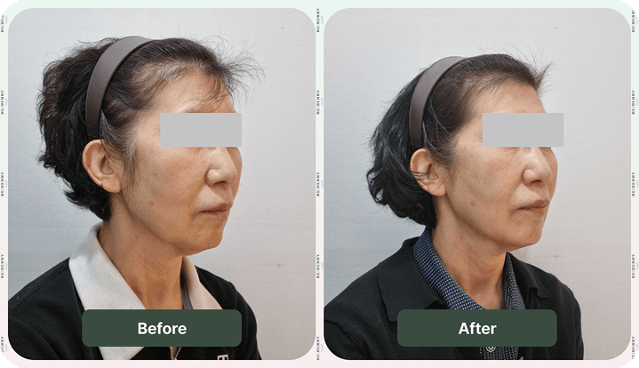 face of woman before and after facial treatment
