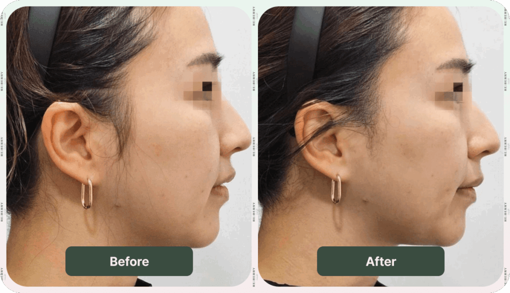 face right profile before and after having onda lifting treatment