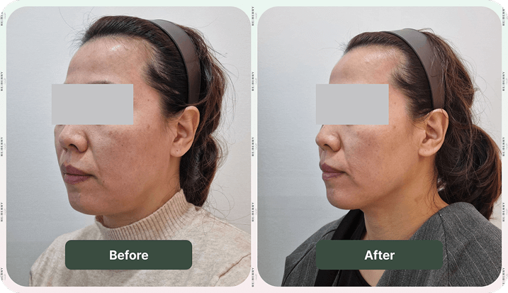 signs on face disappeared after onda lifting treatment at reberry clinic in korea