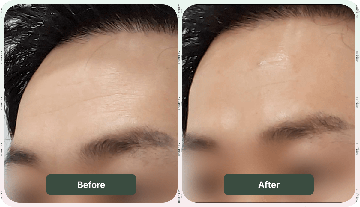 forehead of a man before and after botox at reberry