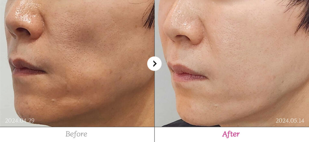 Filler before and after - RE:BERRY