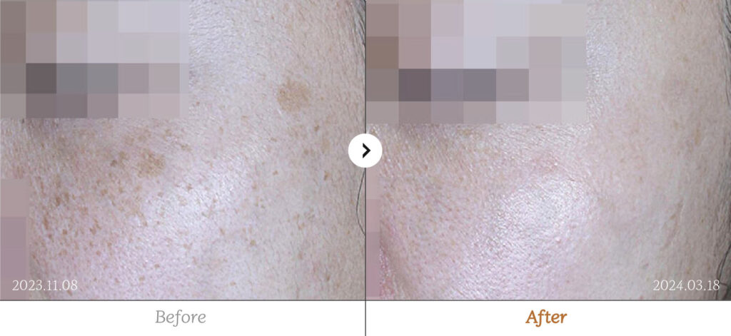 Pigmentation before and after - RE:BERRY