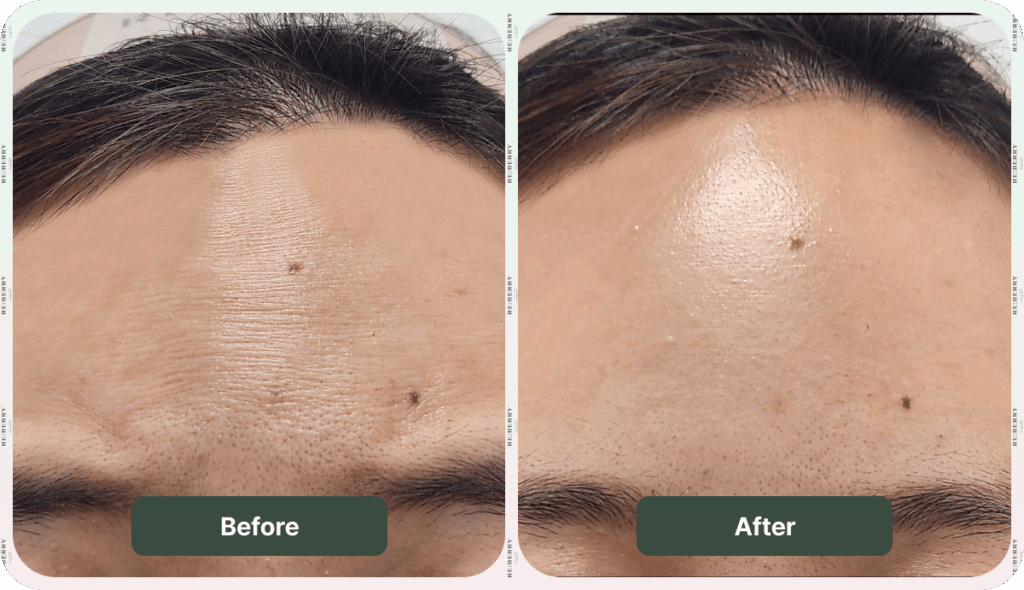forehead of woman before and after botox at reberry