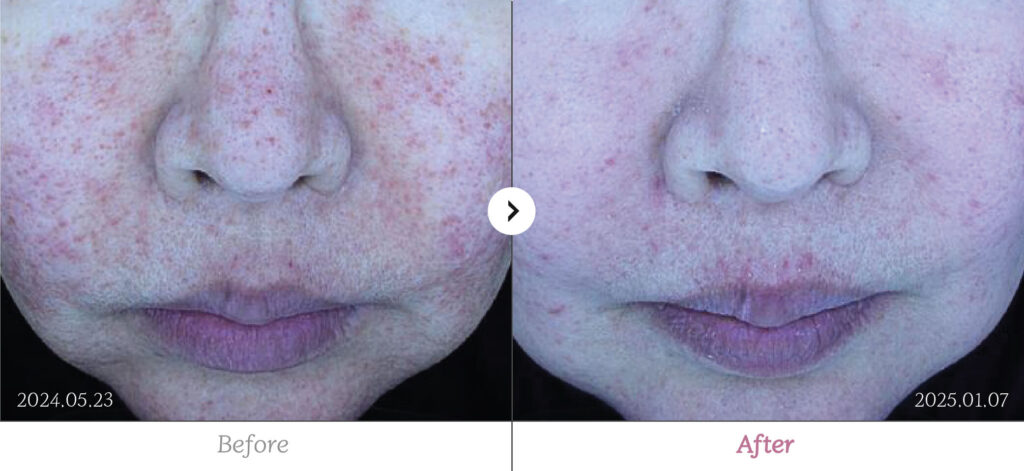 Redness before and after - RE:BERRY