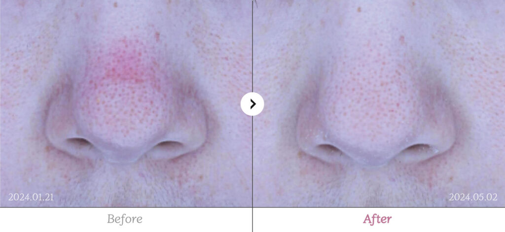 Redness before and after - RE:BERRY