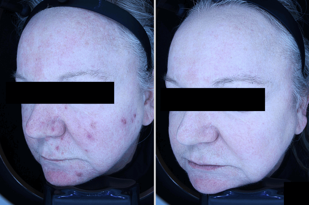 face of an aged person before after titanium lifting at reberry