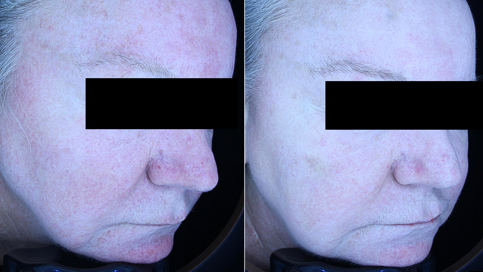 face of a old man before and after titanium lifting treatment