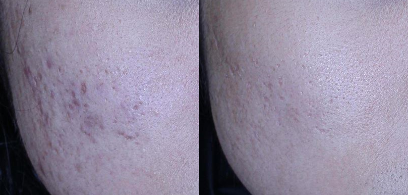 right cheek before and after titanium lifting treatment
