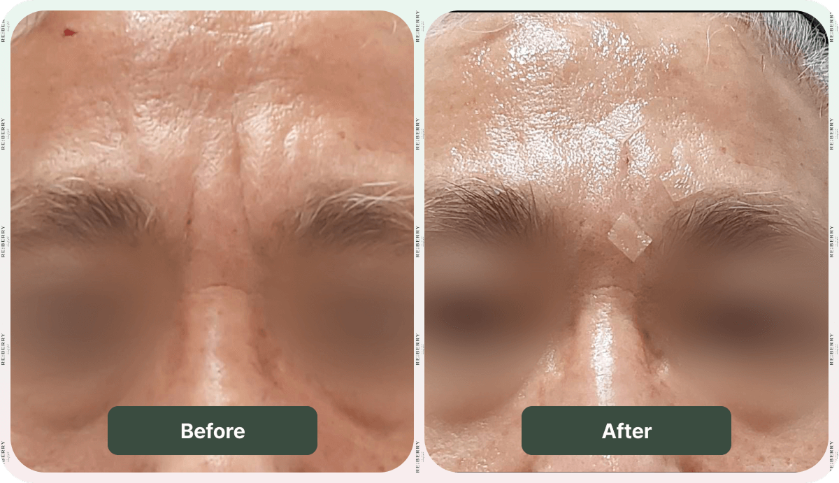 facial treatment before and after result