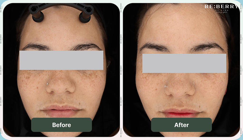 face before and after acne scars treatment