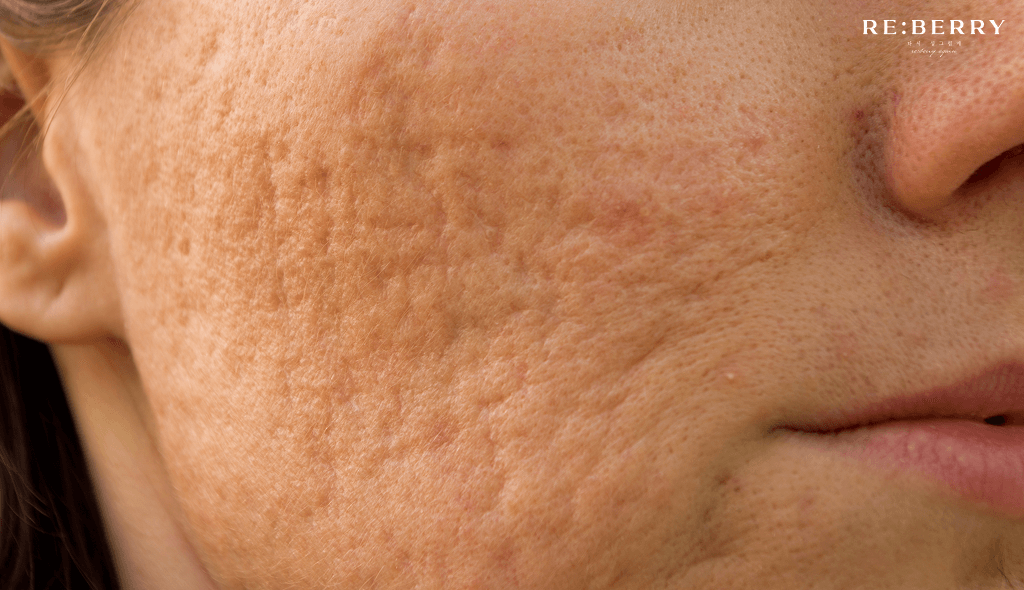 artrophic scars on face of an aged woman