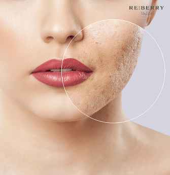 focused on acne scar on the face of a woman