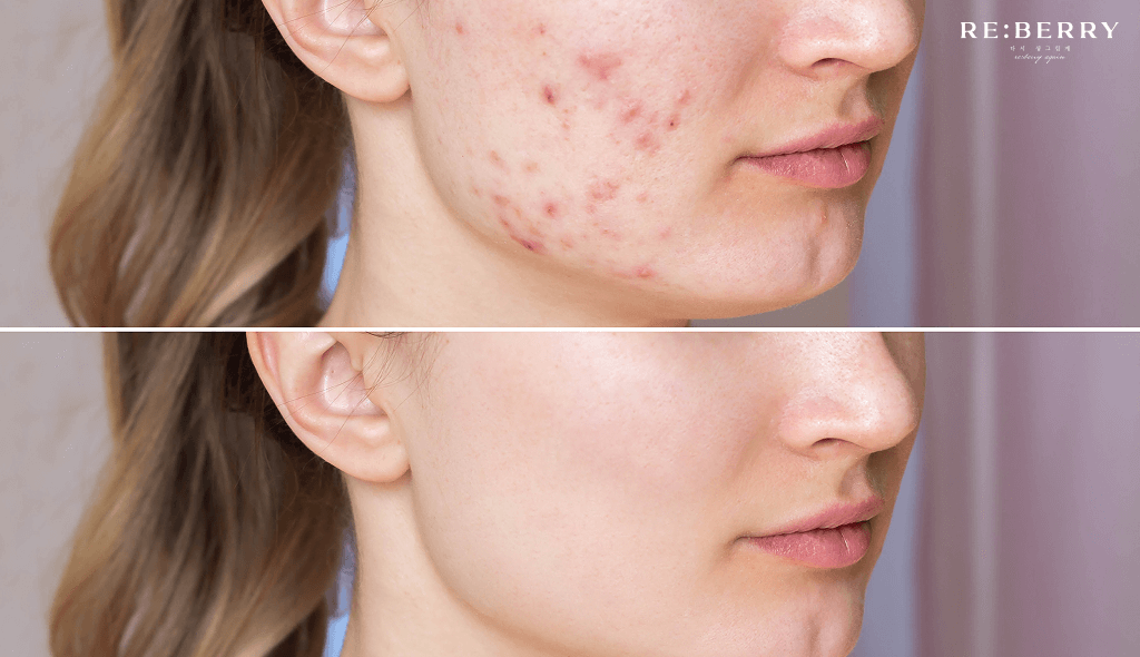 acne scars on face of woman before and after treatment