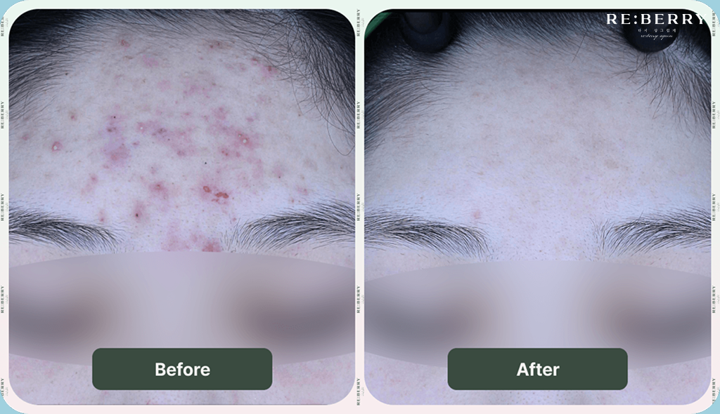 pimples on forehead before and after laser treatment