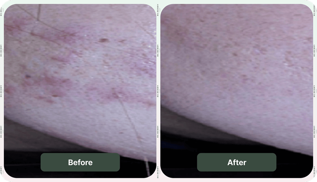 scars on cheek of woman before and after botox injection treatment