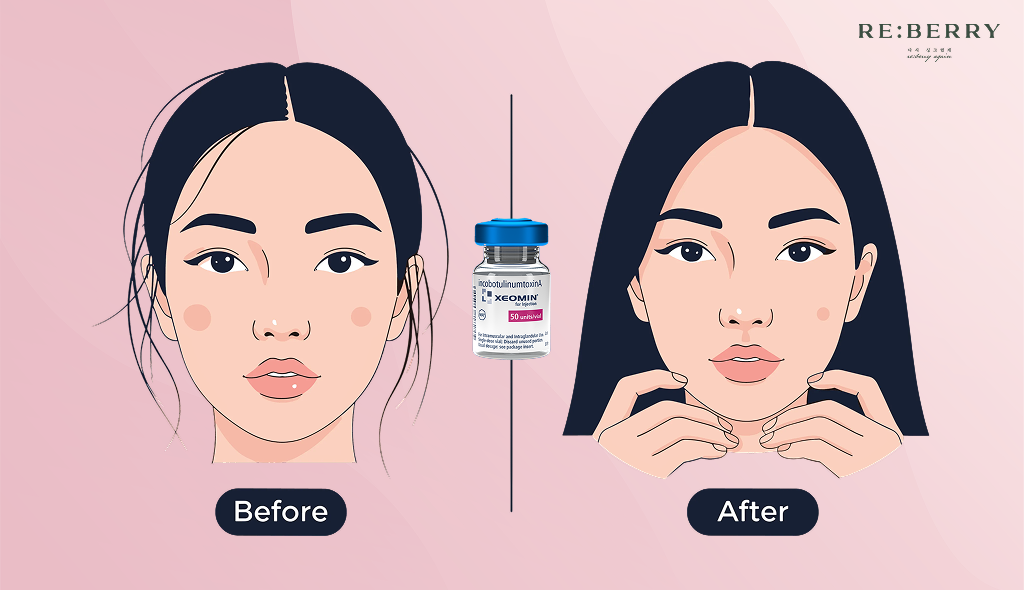 graphical representation of girl achieving v shape with botox injection